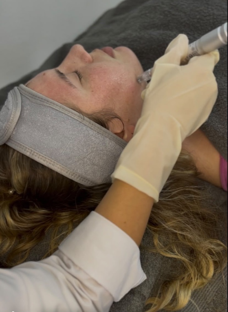Mayra haciendo un tratamiento facial con dermapen